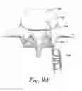 Fig. 10 - Spinal fusion implant