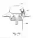 Fig. 12 - Spinal fusion implant