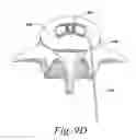 Fig. 13 - Spinal fusion implant