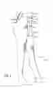 Fig. 02 - Medical compression garment and donning method