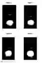 Fig. 03 - Pharmaceutical composition comprising plasminogen and uses thereof