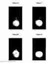 Fig. 04 - Pharmaceutical composition comprising plasminogen and uses thereof