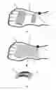 Fig. 01 - Devices, Systems and Methods for Treating Urological and Gastrointestinal Disorders by Electrical Stimulation of the Foot
