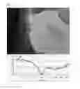 Fig. 16 - Method of Detecting Potential Deep Tissue Injury