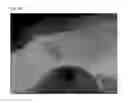 Fig. 19 - Method of Detecting Potential Deep Tissue Injury