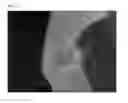 Fig. 22 - Method of Detecting Potential Deep Tissue Injury