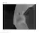 Fig. 24 - Method of Detecting Potential Deep Tissue Injury