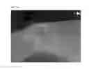 Fig. 29 - Method of Detecting Potential Deep Tissue Injury