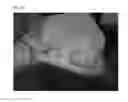 Fig. 32 - Method of Detecting Potential Deep Tissue Injury