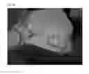Fig. 40 - Method of Detecting Potential Deep Tissue Injury