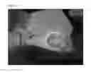 Fig. 46 - Method of Detecting Potential Deep Tissue Injury