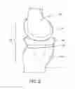 Fig. 03 - System and method of measuring in vivo wear in artificial knee joint