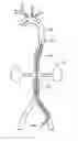 Fig. 01 - AORTIC OCCLUDER WITH TENSIONED BALLOONS