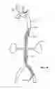 Fig. 04 - AORTIC OCCLUDER WITH TENSIONED BALLOONS