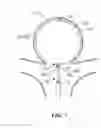 Fig. 09 - Implant detachment with thermal activation