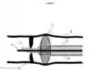 Fig. 05 - Membrane Puncturing Device For Endovascular Surgery