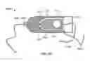 Fig. 35 - Catheter with a double balloon structure to generate and apply a heated ablative zone to tissue