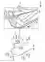 Fig. 48 - Catheter with a double balloon structure to generate and apply a heated ablative zone to tissue