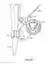 Fig. 51 - Catheter with a double balloon structure to generate and apply a heated ablative zone to tissue