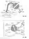 Fig. 57 - Catheter with a double balloon structure to generate and apply a heated ablative zone to tissue