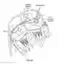 Fig. 63 - Catheter with a double balloon structure to generate and apply a heated ablative zone to tissue