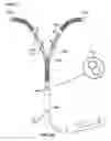 Fig. 78 - Catheter with a double balloon structure to generate and apply a heated ablative zone to tissue
