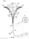 Fig. 80 - Catheter with a double balloon structure to generate and apply a heated ablative zone to tissue