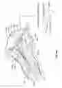Fig. 81 - Catheter with a double balloon structure to generate and apply a heated ablative zone to tissue