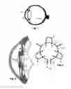 Fig. 02 - Intraocular implant and method for fixing same into an eye