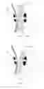 Fig. 02 - Devices and methods for percutaneous endoscopic gastronomy and other ostomy procedures