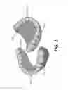 Fig. 02 - Antimicrobial denture