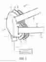 Fig. 02 - Adaptive buckling member in a patient interface