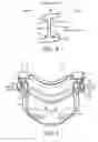 Fig. 07 - Adaptive buckling member in a patient interface