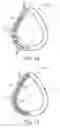 Fig. 08 - Adaptive buckling member in a patient interface