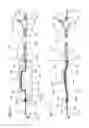 Fig. 02 - ANGIOPLASTY DEVICE