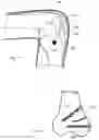 Fig. 07 - MAGNETIC JOINT IMPLANT