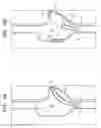 Fig. 06 - Pump for right atrium