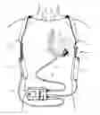 Fig. 01 - Systems for upgrading ventricle assist devices