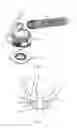Fig. 03 - Systems for upgrading ventricle assist devices