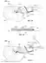 Fig. 07 - Systems and methods for anchoring medical devices