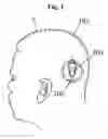 Fig. 02 - Device to control magnetic rotor of a programmable hydrocephalus valve