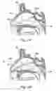 Fig. 04 - Devices, systems and methods useable for treating sinusitis