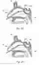 Fig. 07 - Devices, systems and methods useable for treating sinusitis
