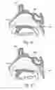 Fig. 08 - Devices, systems and methods useable for treating sinusitis
