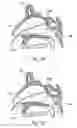 Fig. 09 - Devices, systems and methods useable for treating sinusitis