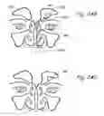 Fig. 16 - Devices, systems and methods useable for treating sinusitis