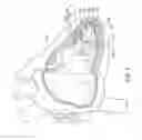 Fig. 02 - Leadless cardiac pacemaker with retrieval features