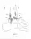 Fig. 02 - Intra joint stabilization construct