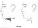 Fig. 85 - Pixel array medical systems, devices and methods