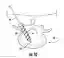 Fig. 08 - Surgical system, device, and method for implanting a surgical device without the use of a guide wire